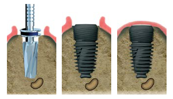 implant aubagne