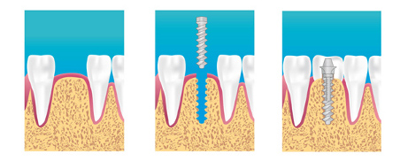 implant aubagne