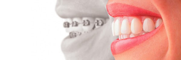 invisalign aubagne